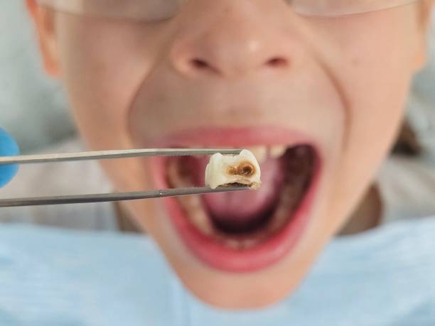 Best Broken or Chipped Tooth Repair in Cuba City, WI