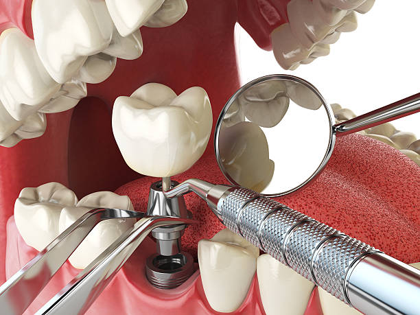 Best Broken or Chipped Tooth Repair in Cuba City, WI